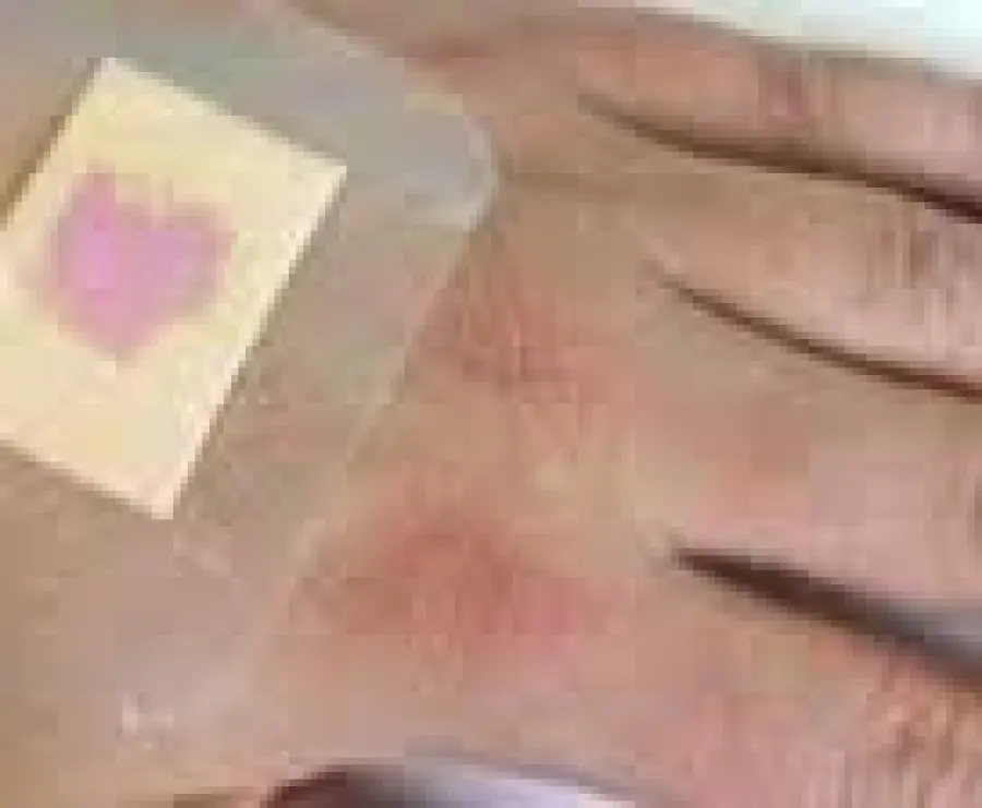 In arrivo il cerotto nanotecnologico che cambia colore se la ferita è infetta