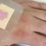 In arrivo il cerotto nanotecnologico che cambia colore se la ferita è infetta