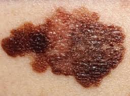 Melanoma: app per diagnosi precoce