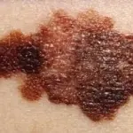 Melanoma: app per diagnosi precoce