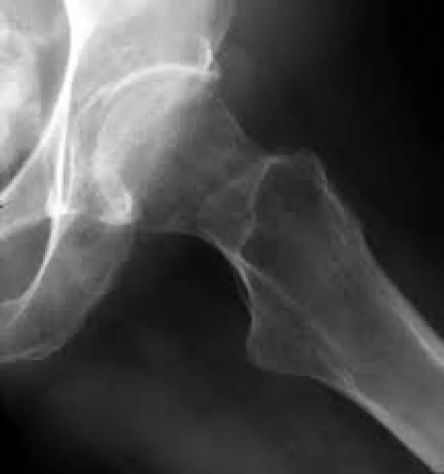 Osteoporosi: come prevenirla con la vitamina D