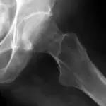 Osteoporosi: come prevenirla con la vitamina D