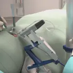 Robot chirurgo opera paziente alla vista: è il primo intervento al mondo