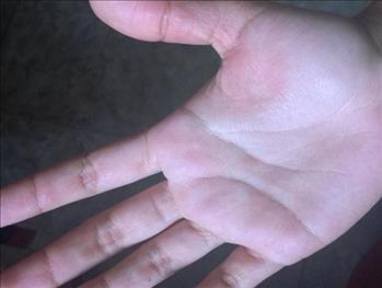 Melanoma, scoperto come bloccare la sua diffusione nell'organismo