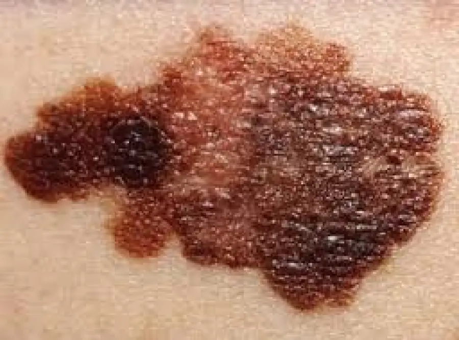 Scoperta molecola che combatte il melanoma: ecco come agisce