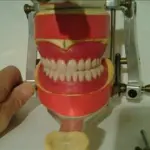 Primo trapianto di mandibola eseguito a Padova